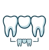 Dental Bridges